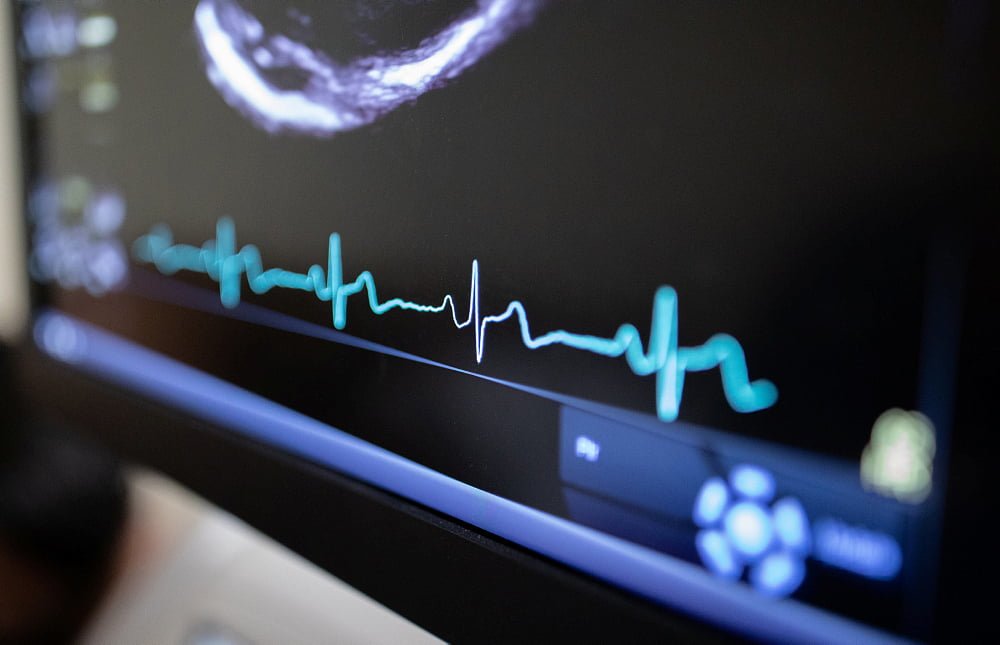 Bild på hjärtrytmkurva.