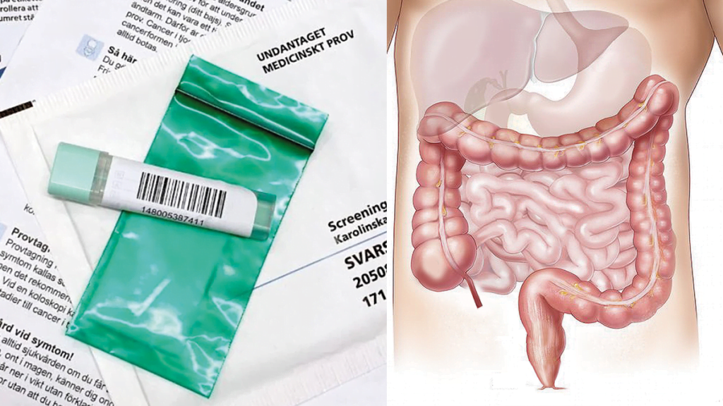 Ëtt provtagningskit och en skiss över tjocktarmen och ändtarmen.